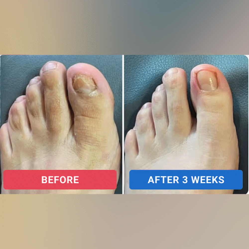 ODALIT™ Nail Repair Patches