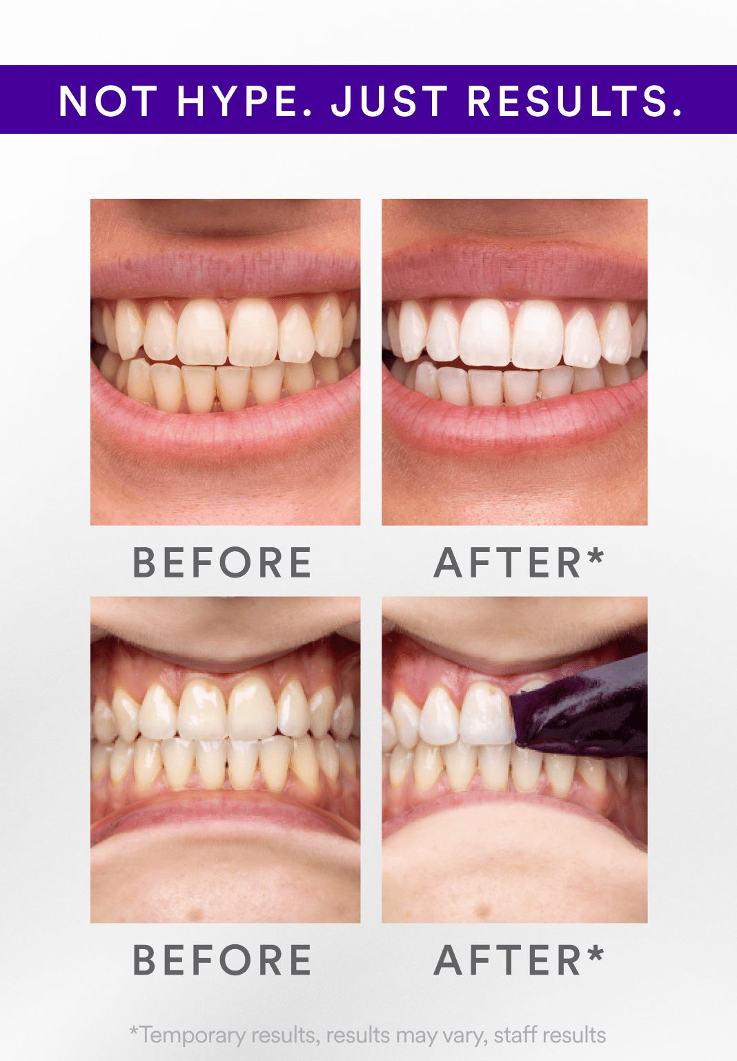 ODALIT™ V34 Whitening Strips