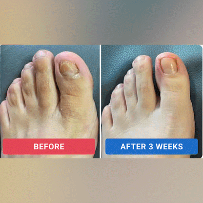 ODALIT™ Nail Repair Patches