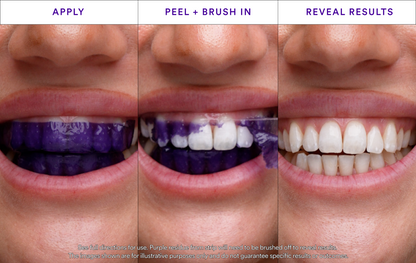 ODALIT™ V34 Whitening Strips